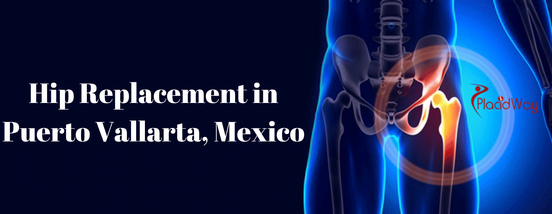 Hip Replacement in Puerto Vallarta, Mexico